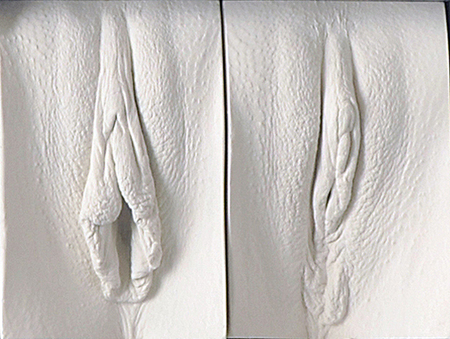 Detail showing a vulva pre and post labiaplasty.