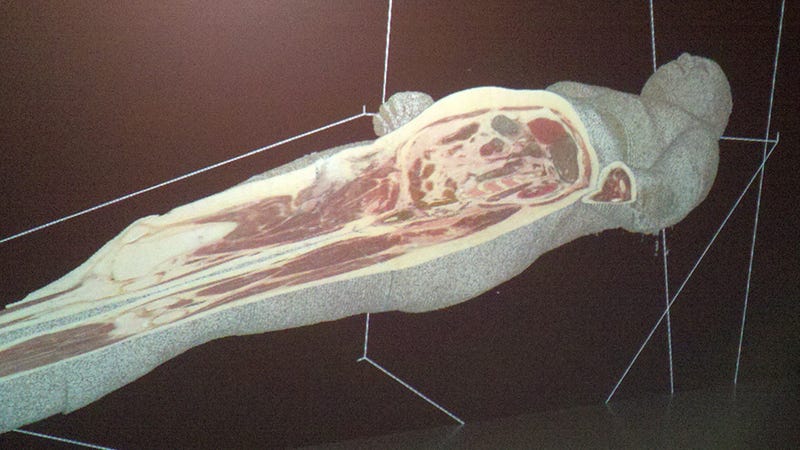 Train for Surgery Using Immersive 3D Holograms of Corpses