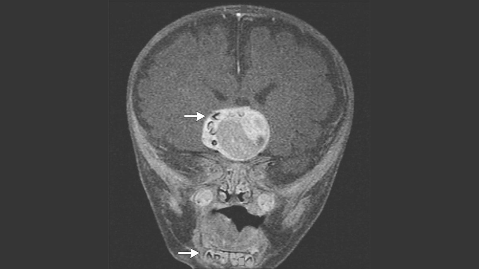 Surgeons shocked to find fully formed teeth in a baby's brain tumor