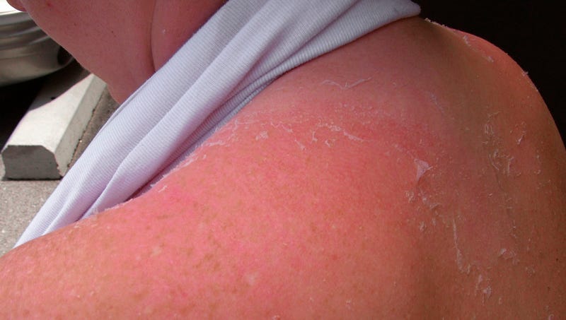 Illustration for article titled The Onion's Tips For Treating A Sunburn