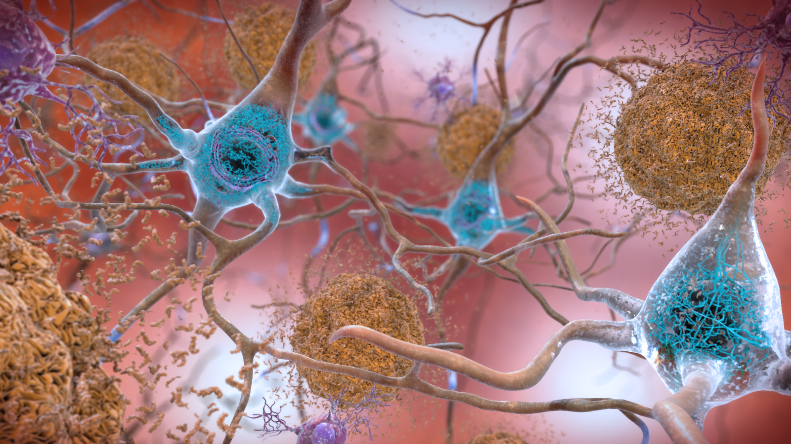 experts-want-to-redefine-alzheimer-s-disease-so-they-can-study-it-better