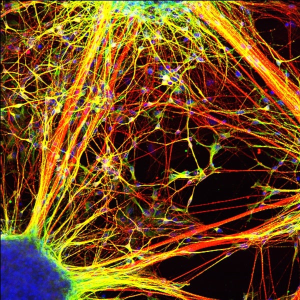 This is what schizophrenia looks like at the molecular level