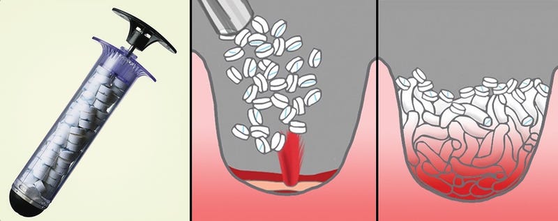 Illustration for article titled La jeringuilla que tapona heridas de bala en 15 segundos, aprobada para uso médico