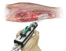 Illustration for article titled Spray on Skin Gun Shoots Stem Cells To Heal Your Open Wounds