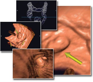Illustration for article titled Scientists Say Virtual Imaging Colonoscopy As Good As Real Thing, With Less Probing