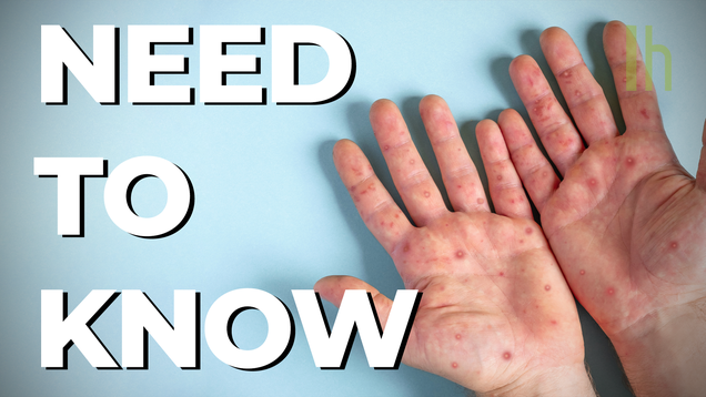 What Do I Need to Know About Monkeypox?