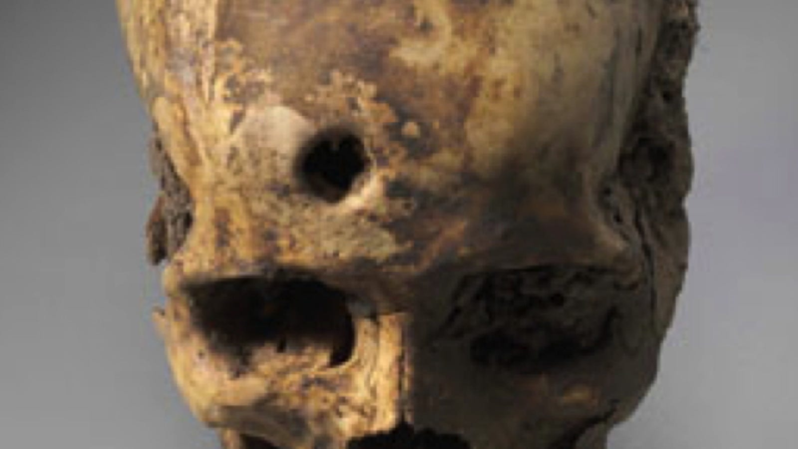 The Lost Civilizations That Pioneered Skull Surgery