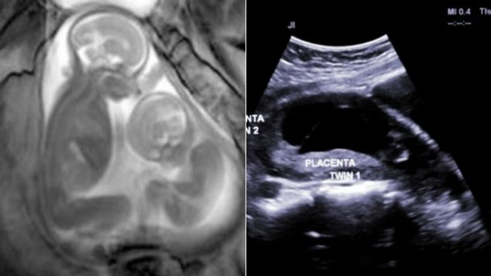 Video MRI Shows Unborn Twins in Incredible Detail