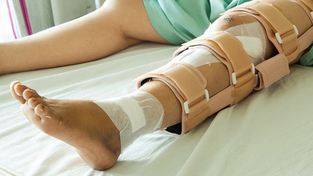Woman Fractures Legs Repeatedly in Order to Become 6-Foot-Tall Model
