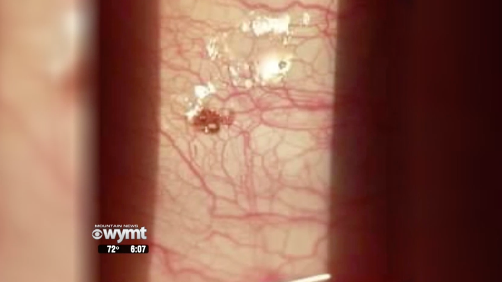 Tick Lodged on Kentucky Man's Eyeball Made 'Popping Sound' When Doctor Pulled It Off
