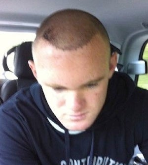 Illustration for article titled Wayne Rooney's Bloody Hair Plugs Are Literally Bloody