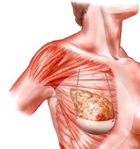 Illustration for article titled Surgically Implanted Bra is Like an External Bra, but With More Horrible Surgery Involved