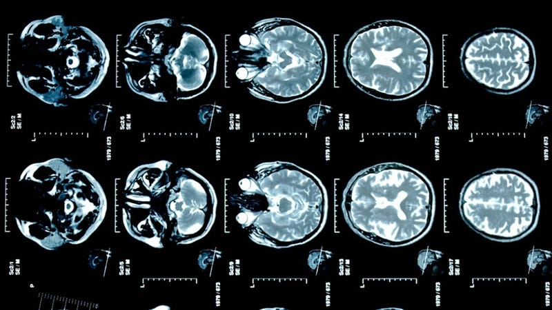 Illustration for article titled Female Brain Recovers More Quickly From Alcoholism Than the Male Brain