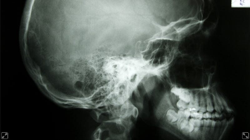 dental-x-rays-linked-to-the-most-common-brain-tumors