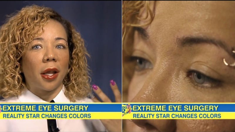 How Tiny S Eye Color Changing Surgery Actually Works   Xsgjspgyjpafw9pjp6bz 