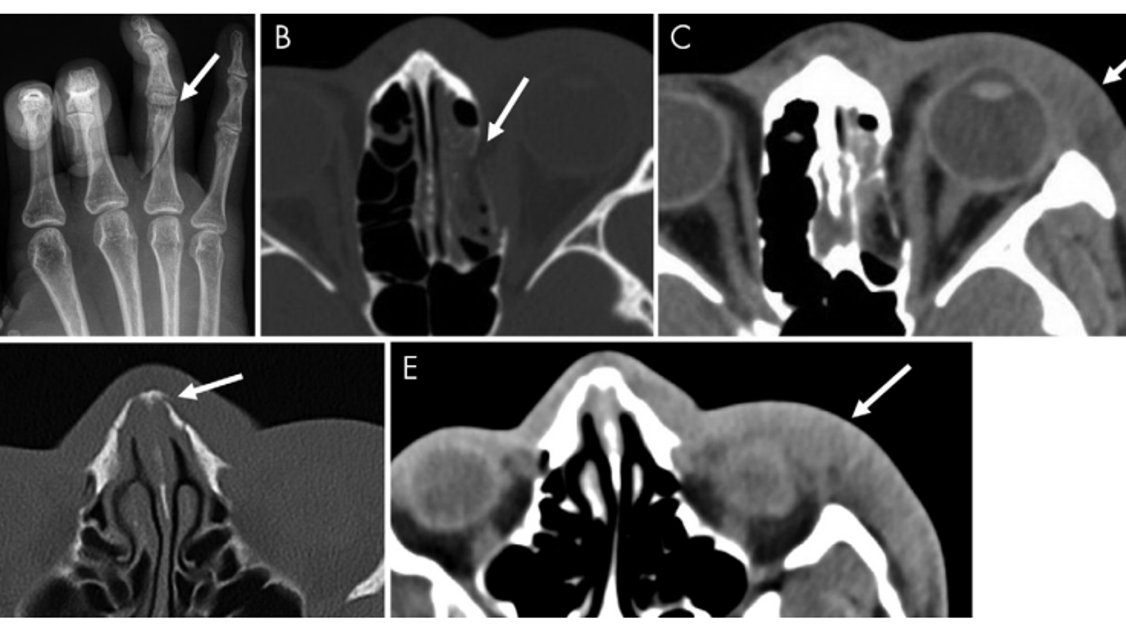 Researchers Study How XRays Can Be a Flag for Domestic Violence