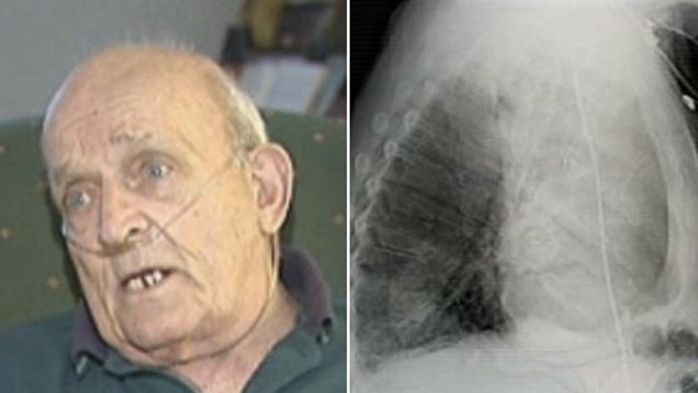 This Man Had A Plant Growing Inside His Lung