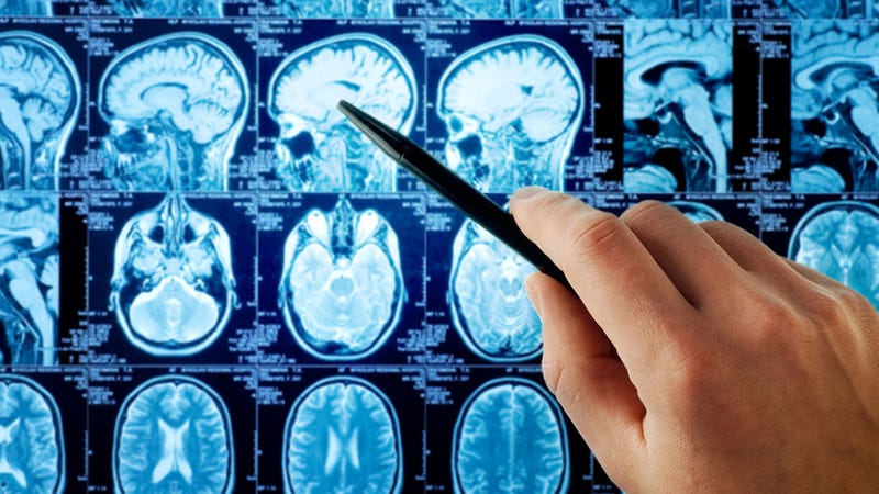 Illustration for article titled 24-Year-Old Woman Actually Missing a Large Part of Her Brain