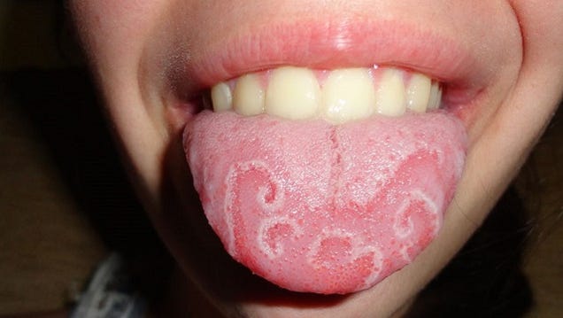 Do You Have A Geographic Tongue?