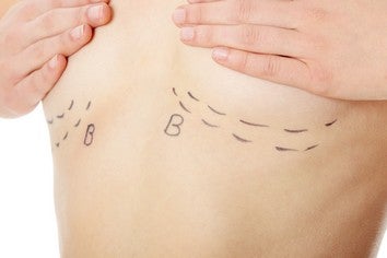 Illustration for article titled Plastic Surgeon Sues Over "Frankenstein Breasts" Yelp Review