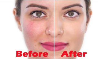 Illustration for article titled how to clear acne overnight