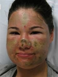 Acid-attack liar Bethany Storro