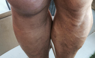 Illustration for article titled Ryback's Staph Infection Is Very Gross