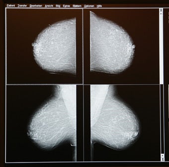 Illustration for article titled Some Doctors Claim Breast Cancer Is Overtreated