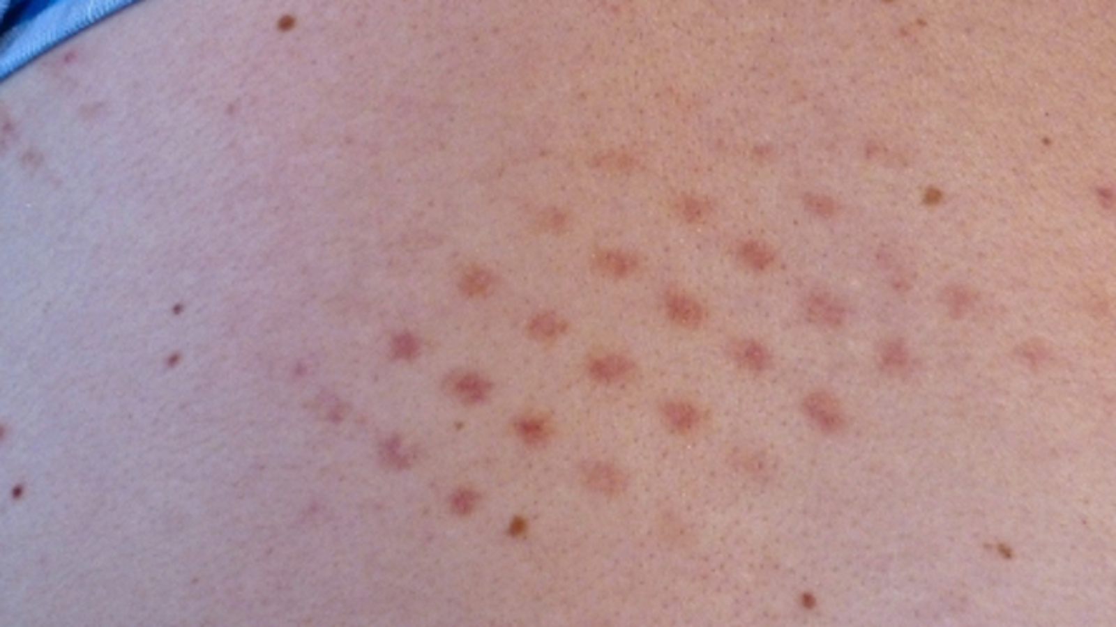 Man Goes To Mets Sleepover, Leaves With Gross Rash