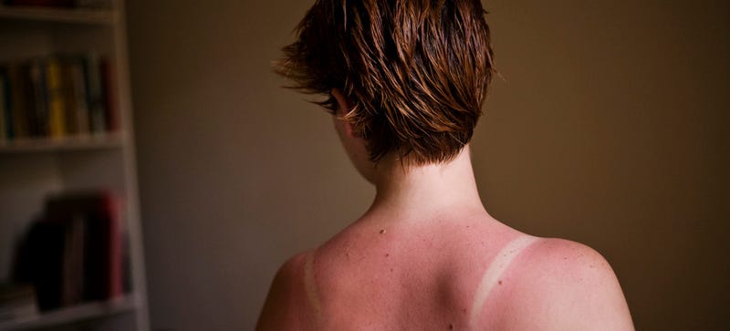 Illustration for article titled Sun Keeps Damaging Skin Cells For Hours After Exposure
