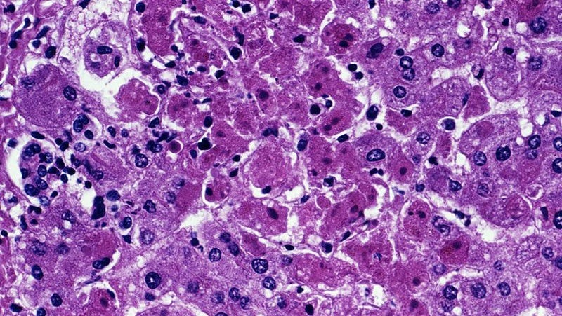 Illustration for article titled This Ebola-Type Fever is Named After a Town in Germany