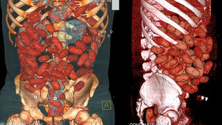 This Guy Stuffed Almost a Kilo of Cocaine Down His Throat