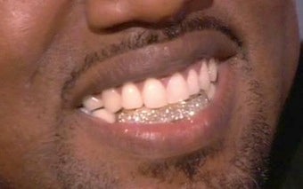 Illustration for article titled Dentist On Kanye's Diamond Teeth: "Good Luck With Oral Hygiene"