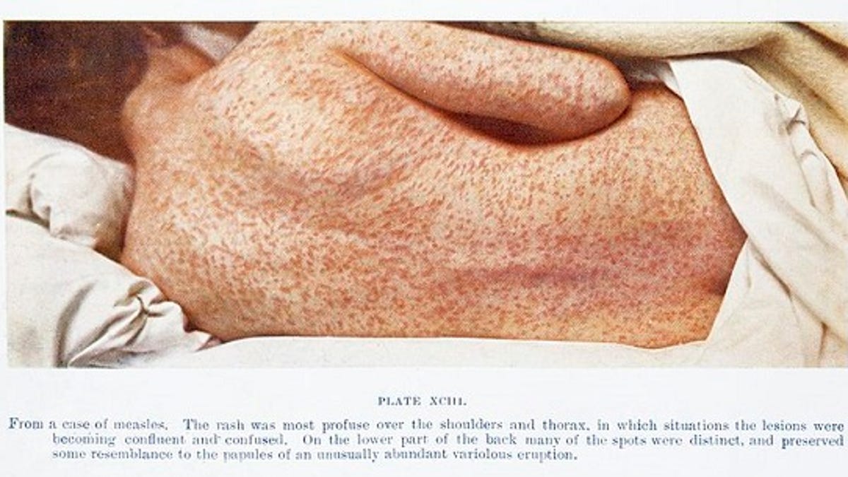 How is measles in an adult How is measles in an adult