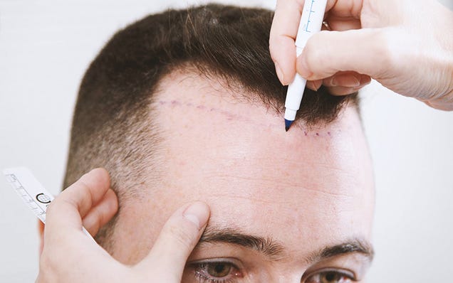 Illustration for article titled Avoid Misleading and Deceptive Hair Transplant Marketing Tactics