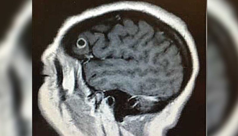 Illustration for article titled Esta mujer tuvo una enorme tenia viviendo un año en su cerebro, y fue la mejor noticia que le pudieron dar