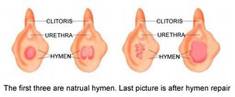 Breaking the hymen and virginity