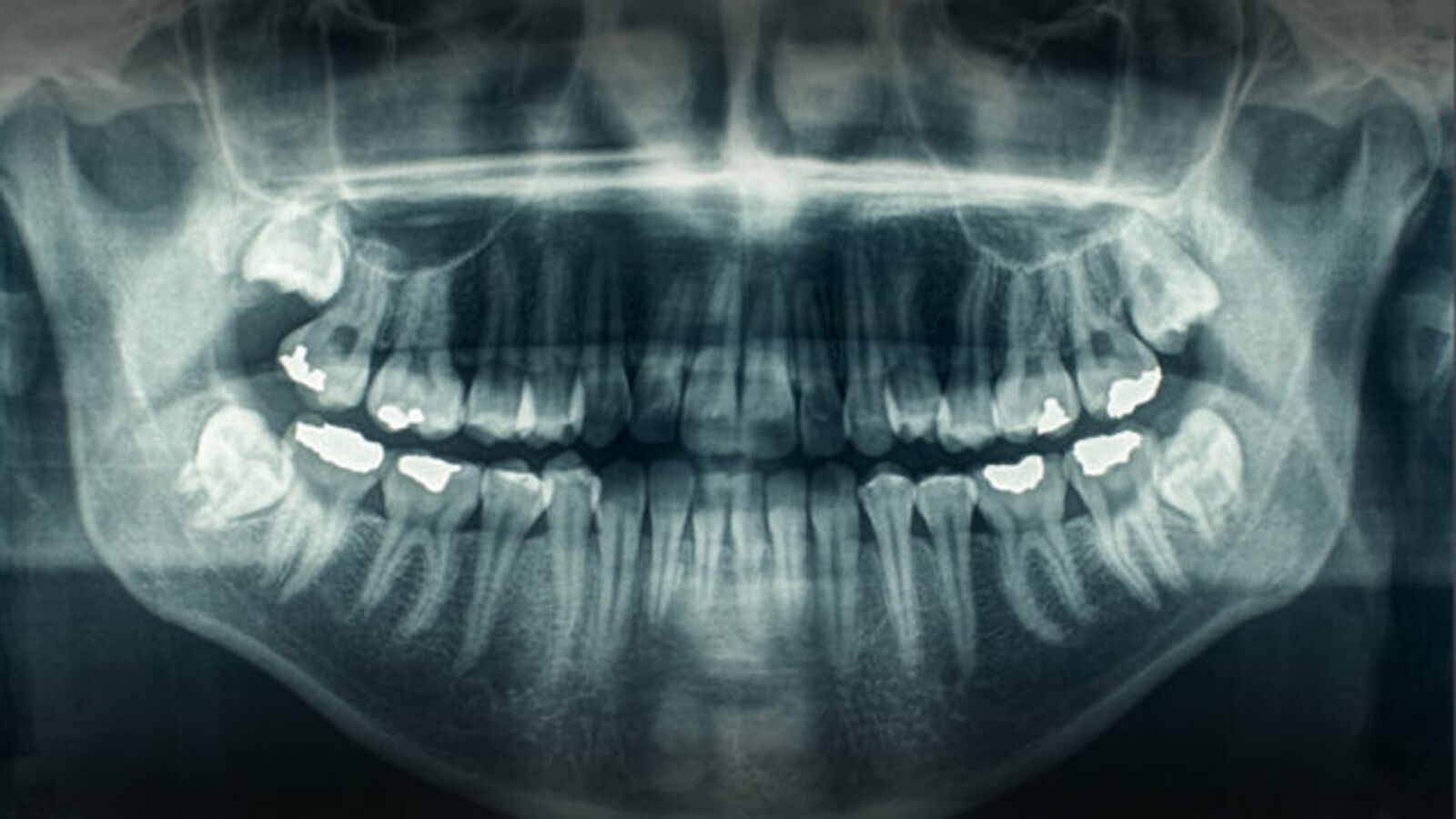 A Motorcycle Rider's Teeth Were Knocked Out By A Golf Ball