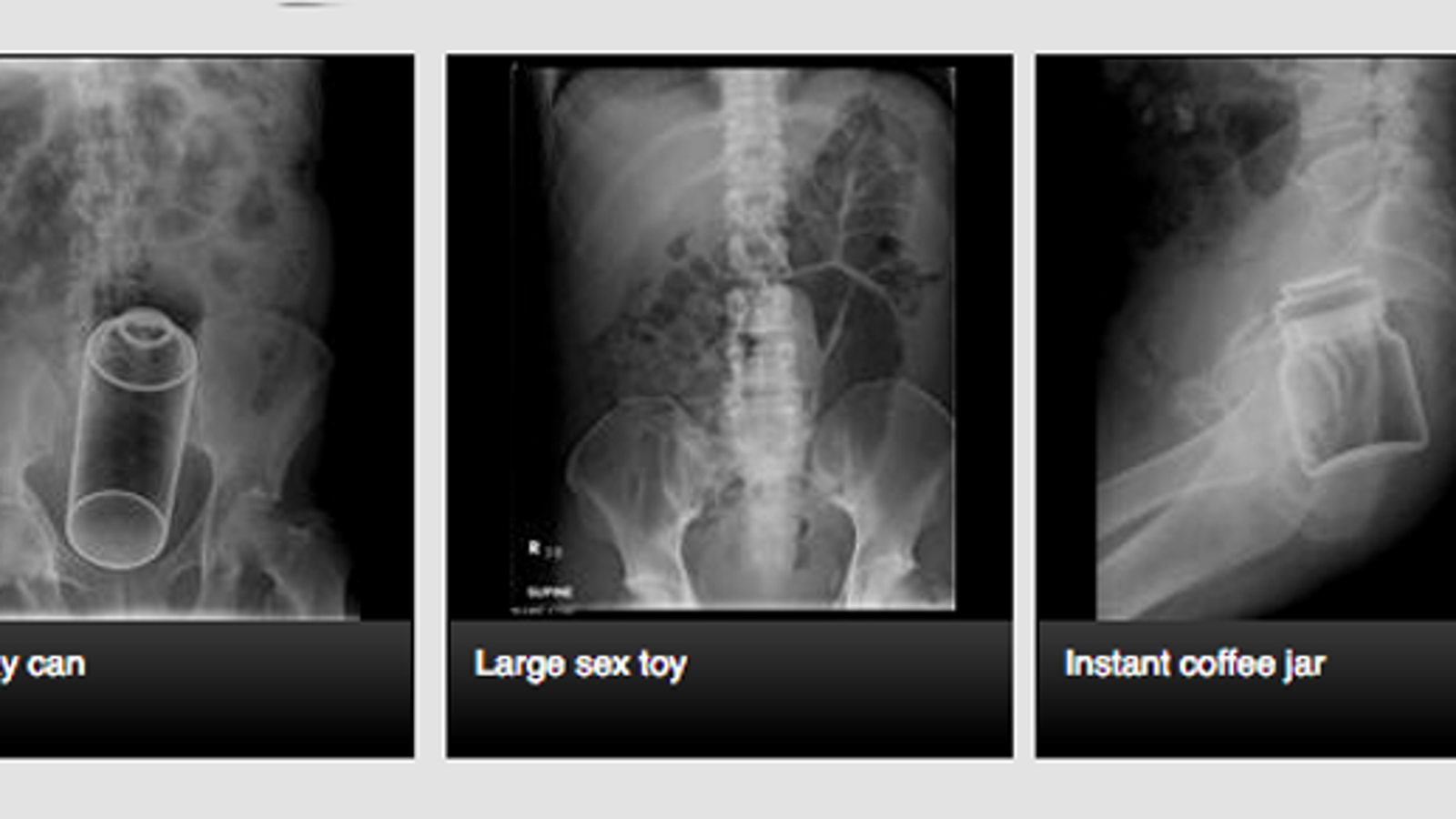 The Site Where Doctors Share X Rays Of Weird Things In Peoples Butts 