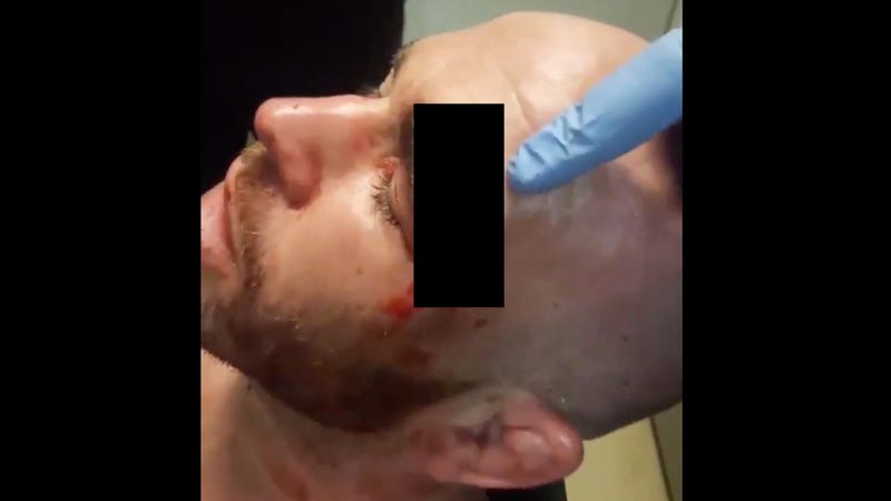 Illustration for article titled MMA Fighter Takes Knee To The Face, Suffers Extremely Gnarly Head WoundÂ