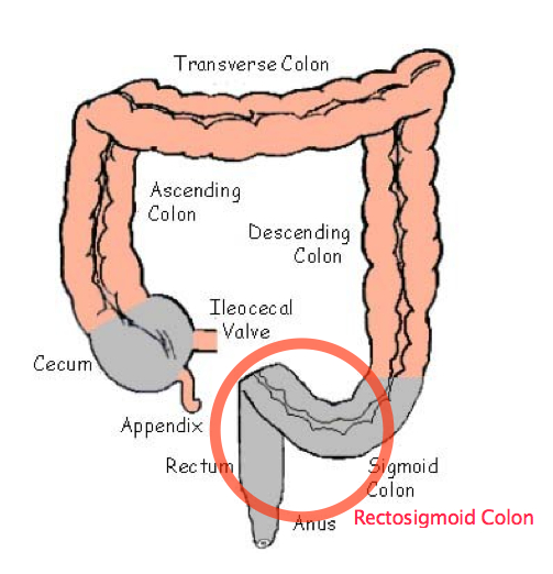 Bildergebnis für rectosigmoid colon coffee