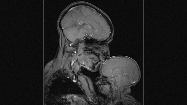 photo of MRI of Mother and Child Shows Love Through The Eyes of Science image