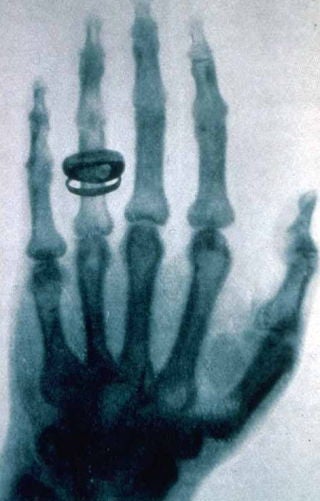 Illustration for article titled This Was The First Human X-Ray Ever Taken