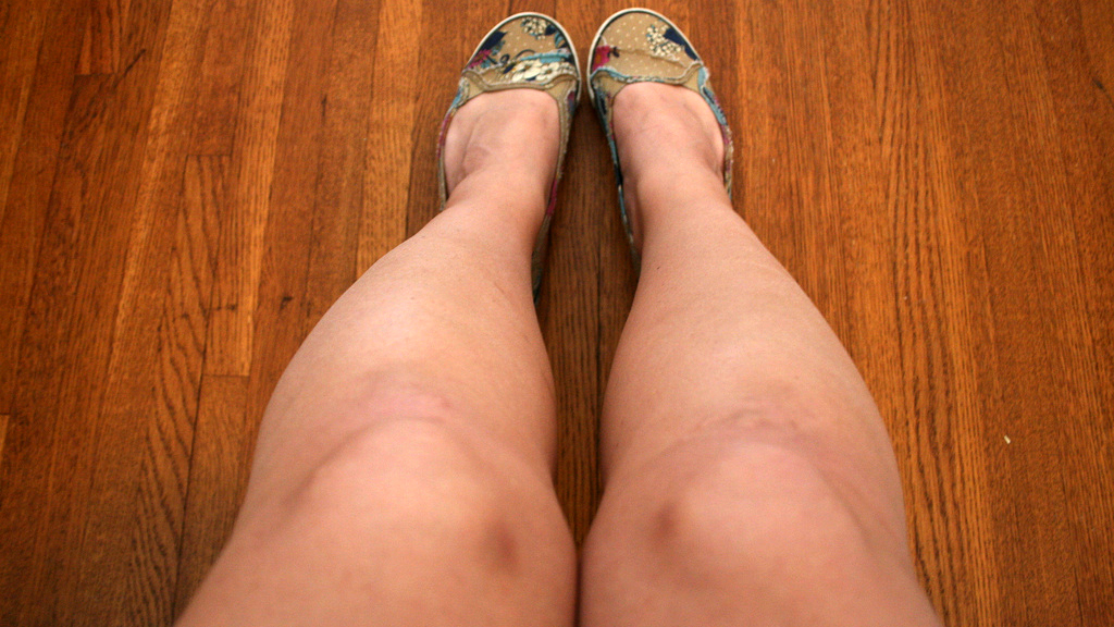 body bruises fitness