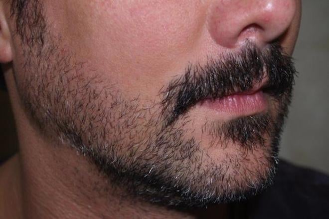 Hipster Beard Transplants Are All the Rage These Days