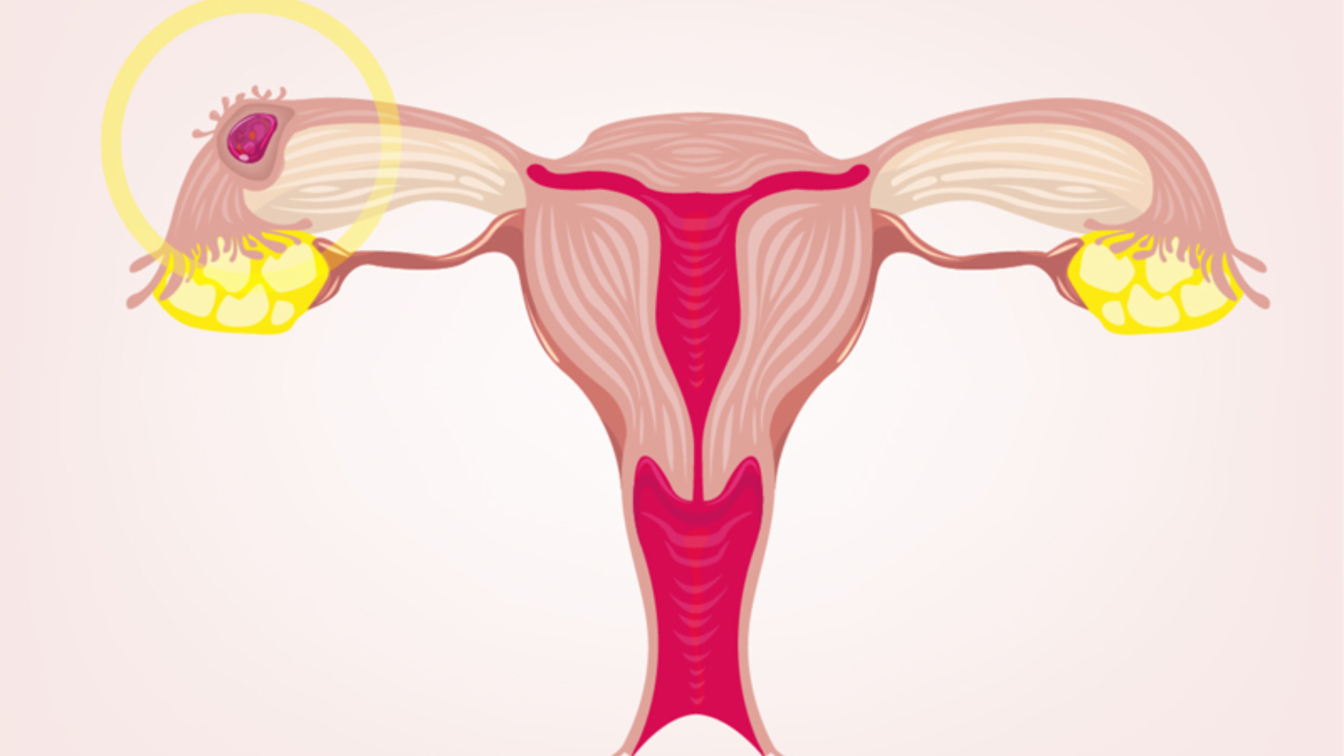 Why An Ectopic Pregnancy Can’t Be ‘Reimplanted’