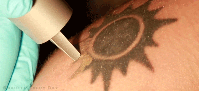 How Removing Tattoos With Lasers Works | Gizmodo Australia