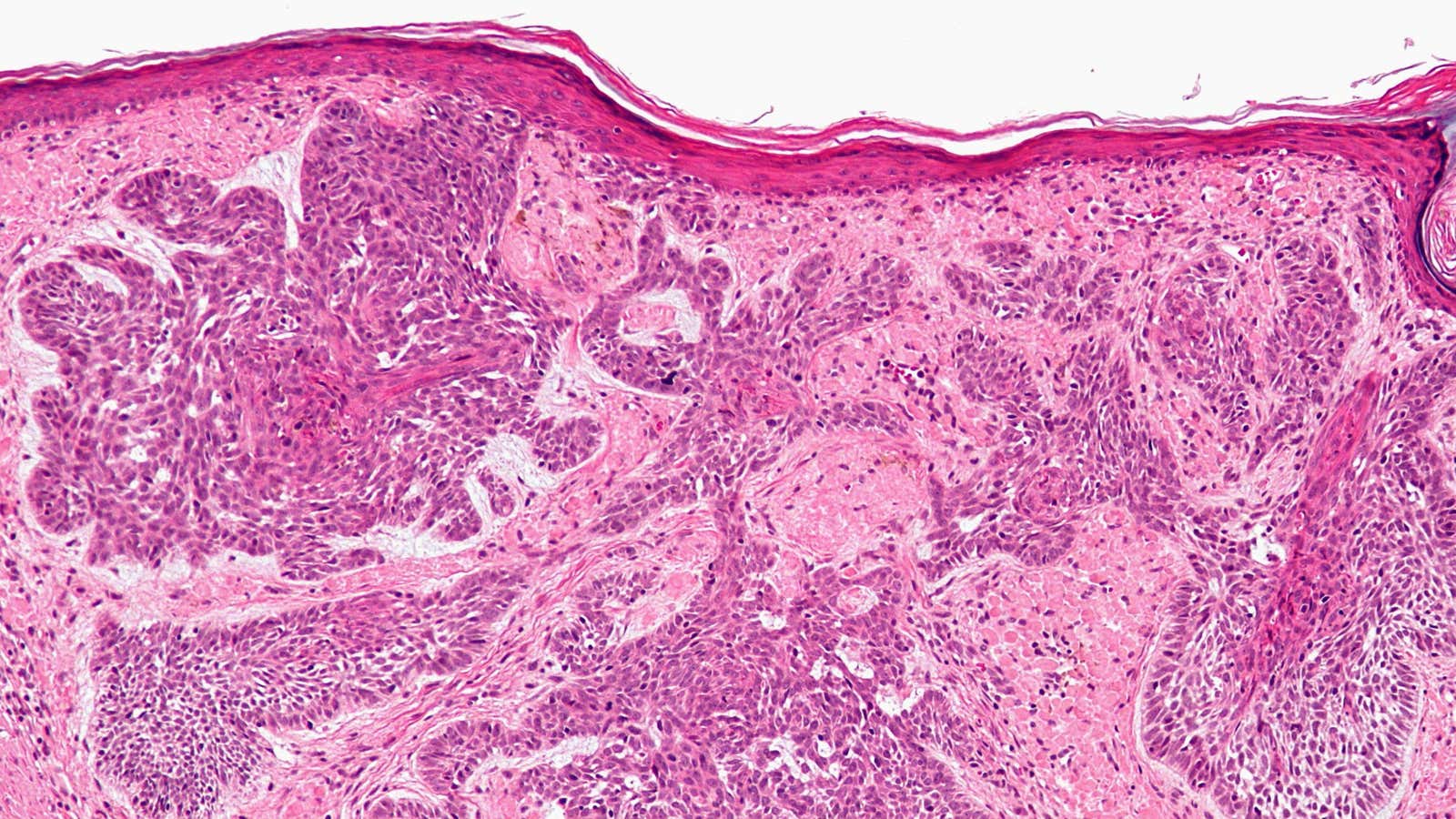 Basal cell carcinoma up close