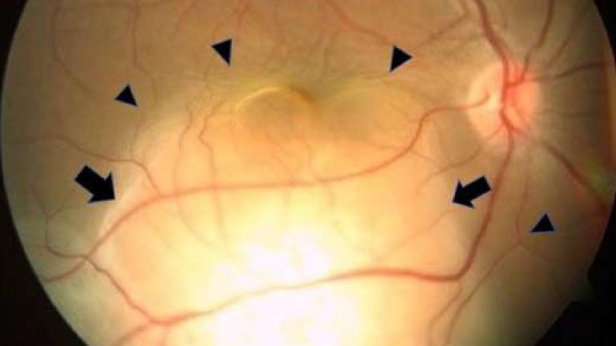 La ceguera repentina de un ojo de una mujer resultó ser cáncer de pulmón