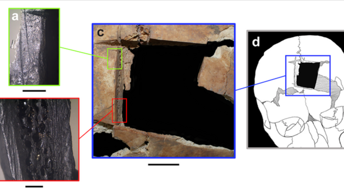 Skull shows man survived surgery to ease brain pressure 2700 years